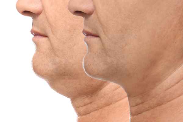 HIFU - Breakthrough in Anti - ageing 2 hifu results Suffolk