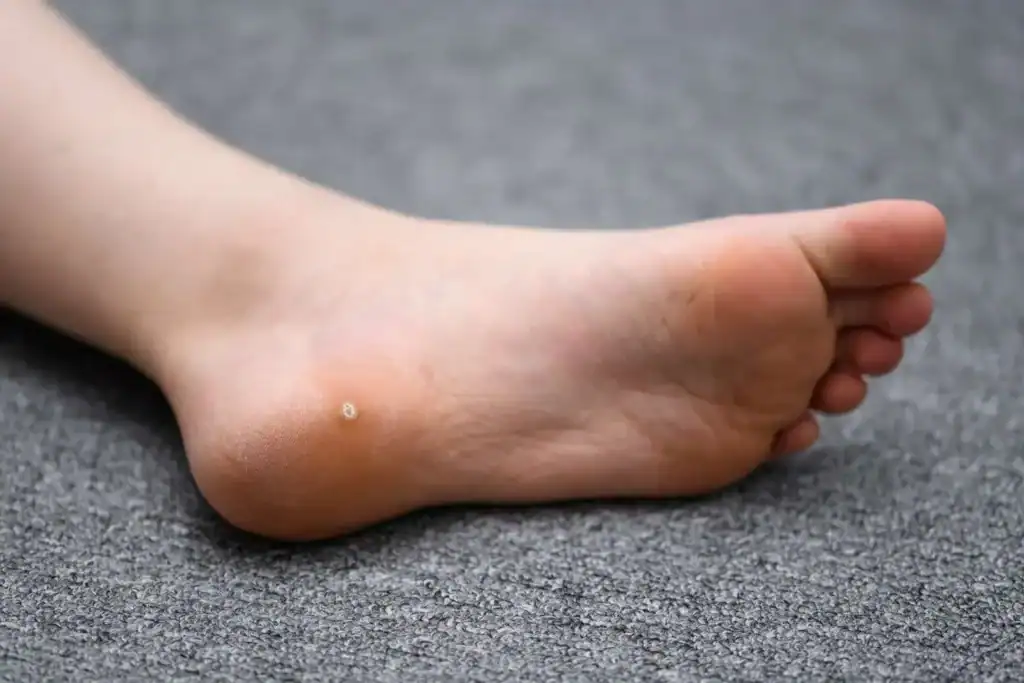 Cryotherapy For Warts And Also Verrucas 2 Image of verruca on the bottom of the foot that able to be treated with Cryotherapy Suffolk