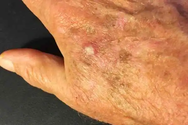 Cryopen For Actinic Keratoses 1 Image of Actinic keratoses Suffolk on a person hand
